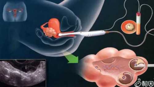 重庆正规代妈公司 重庆市渝中区妇幼保健院做三代试管婴儿移植成功率高吗？